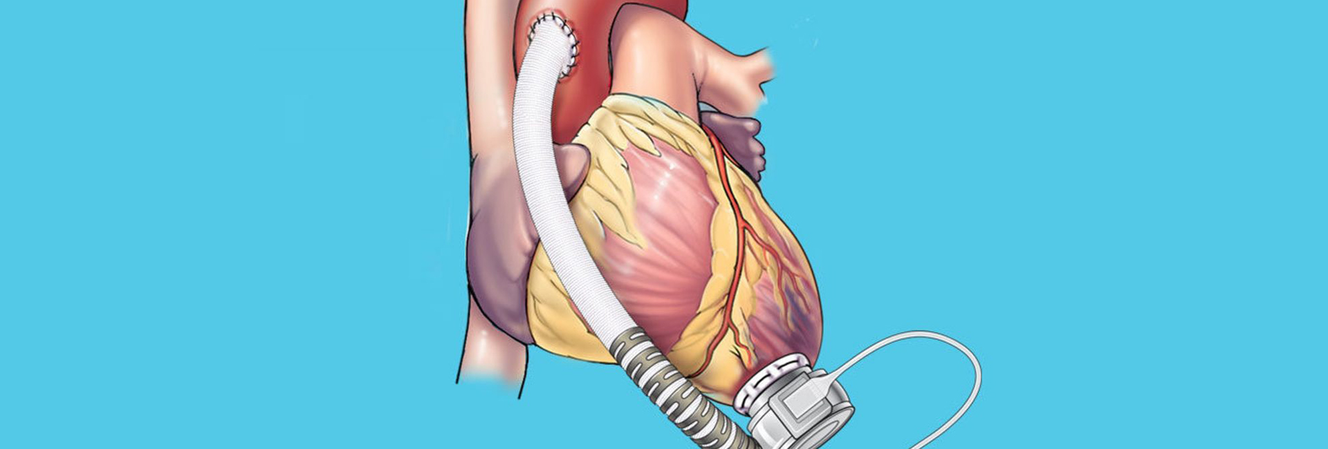 artificial heart