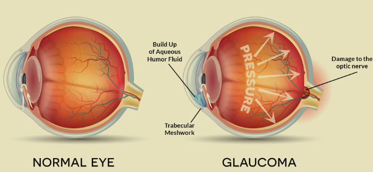 Glaucoma 